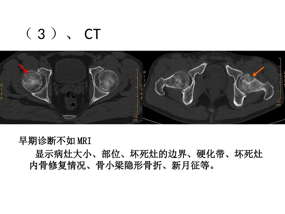 股骨头坏死的诊断及保 髋方法的选择_第14页