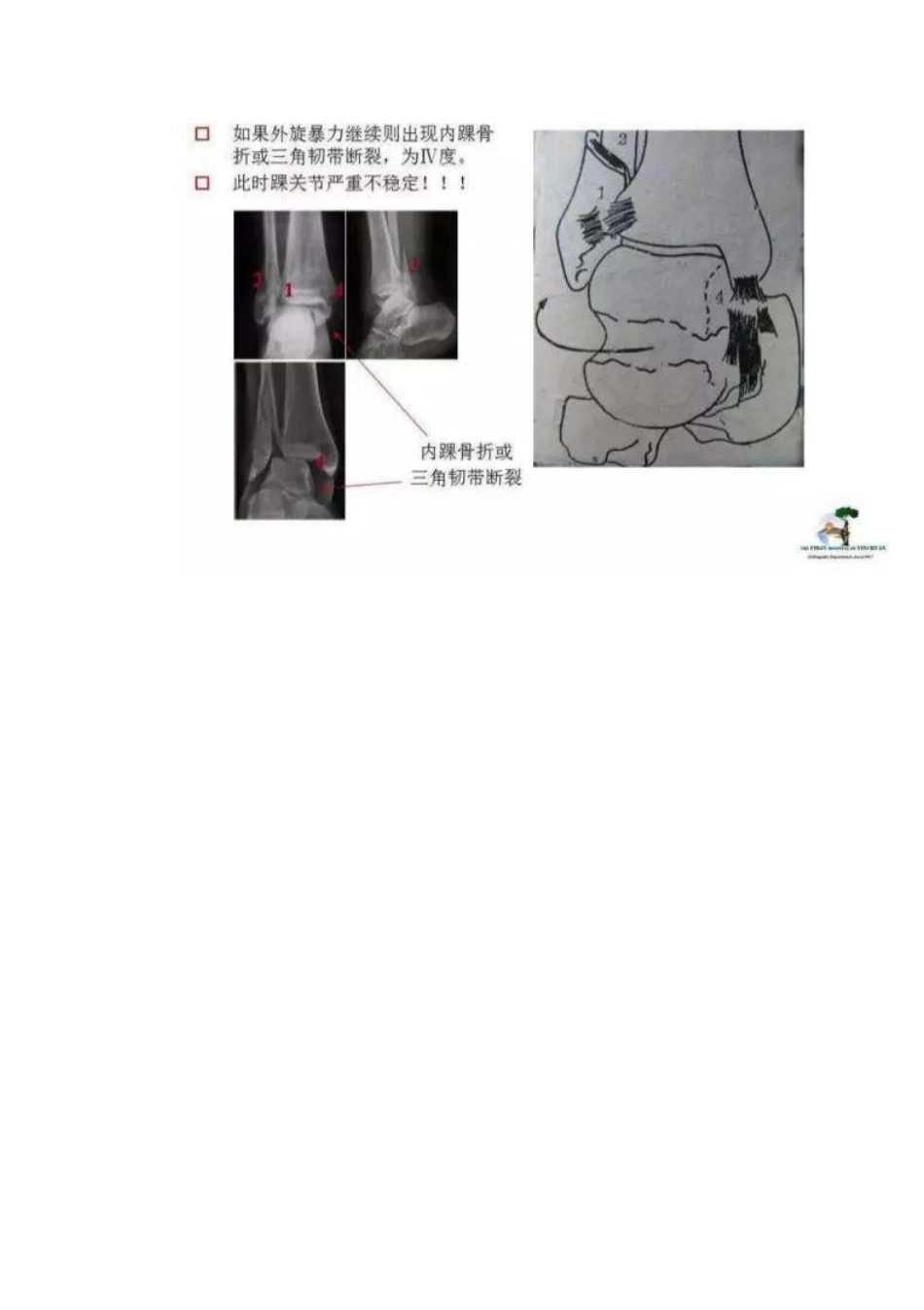 踝关节骨折Lauge-Hansen分型_第10页