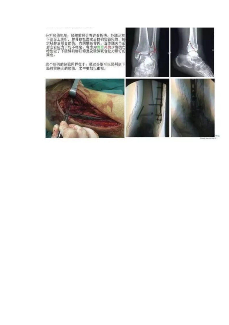 踝关节骨折Lauge-Hansen分型_第12页