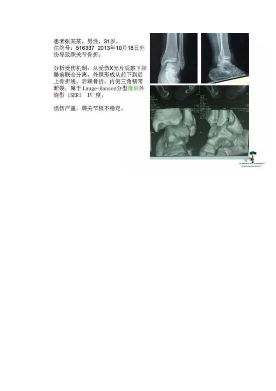 踝关节骨折Lauge-Hansen分型_第13页