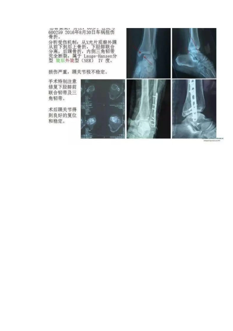 踝关节骨折Lauge-Hansen分型_第15页
