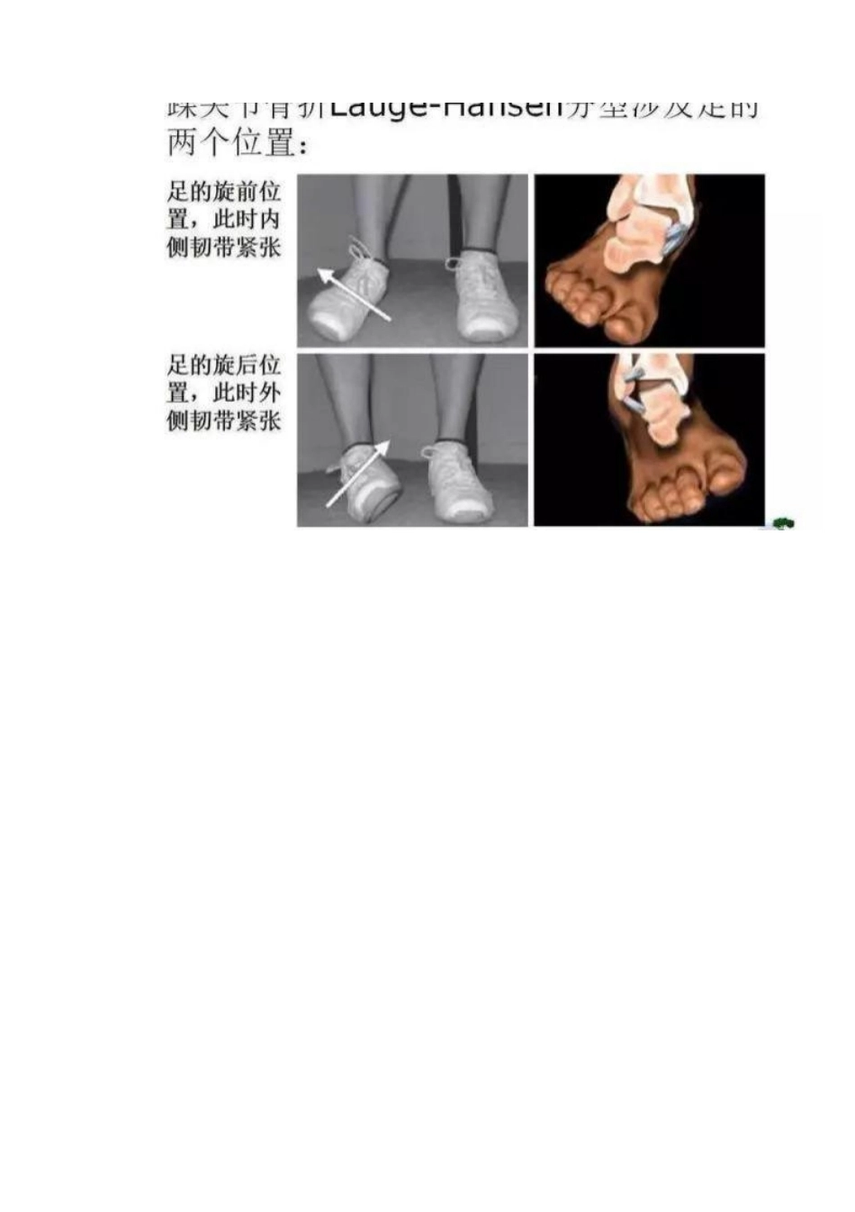 踝关节骨折Lauge-Hansen分型_第3页