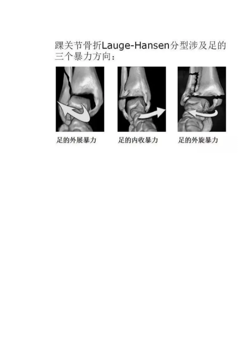 踝关节骨折Lauge-Hansen分型_第4页