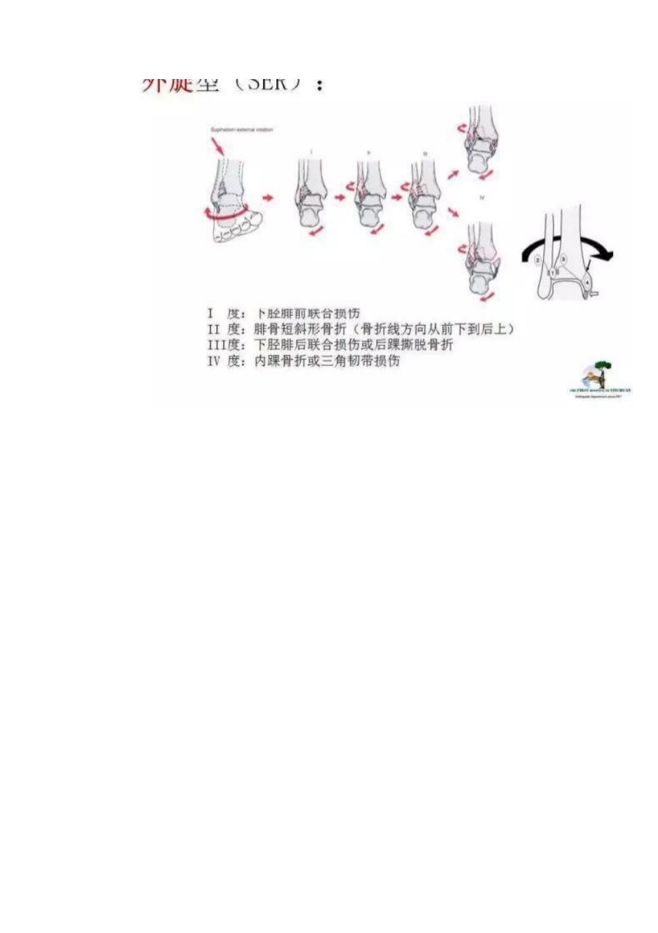 踝关节骨折Lauge-Hansen分型_第7页
