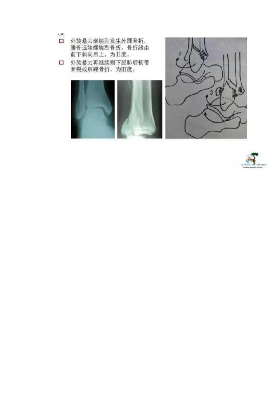 踝关节骨折Lauge-Hansen分型_第9页