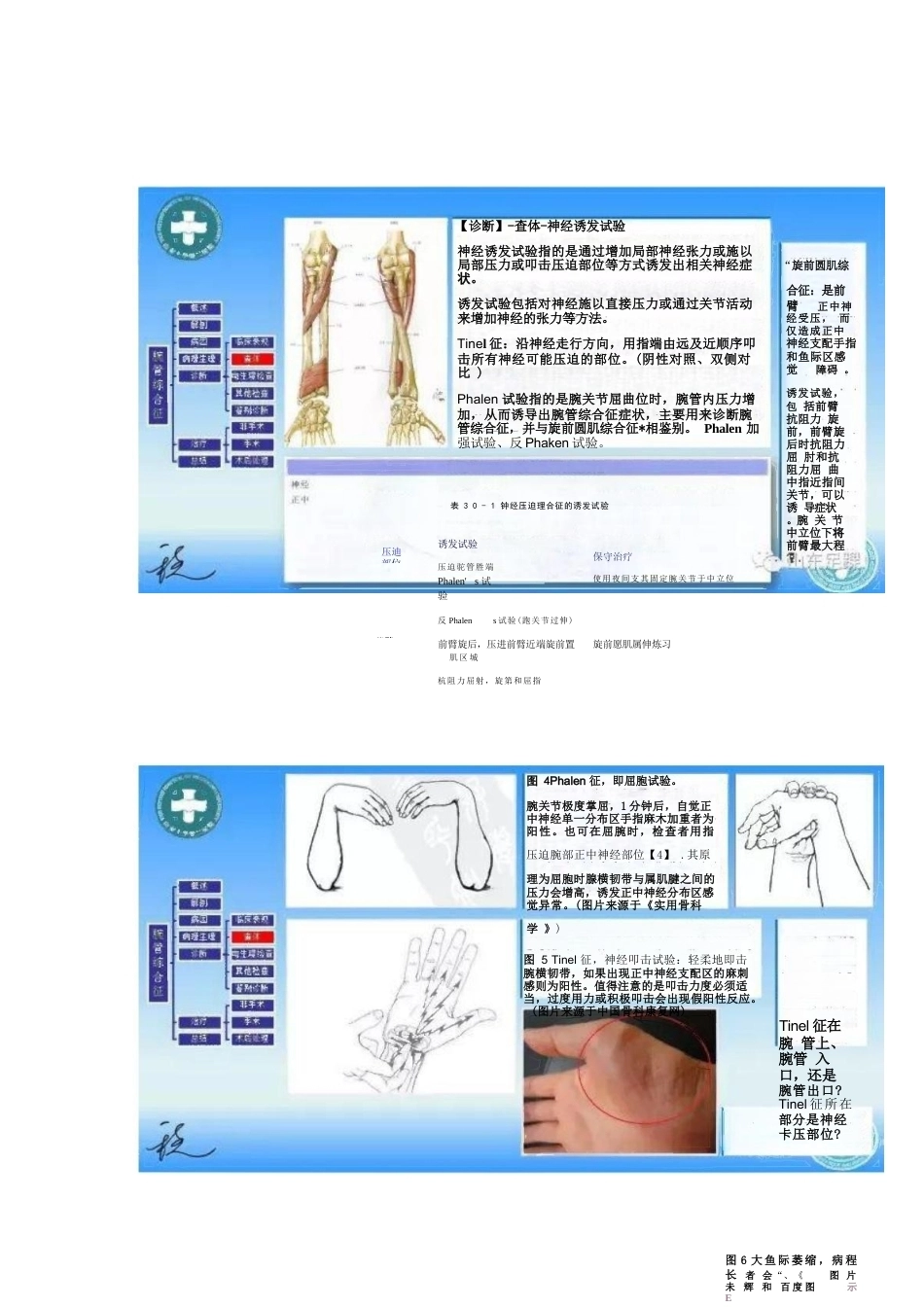 腕管综合征的诊断与治 疗策略_第10页
