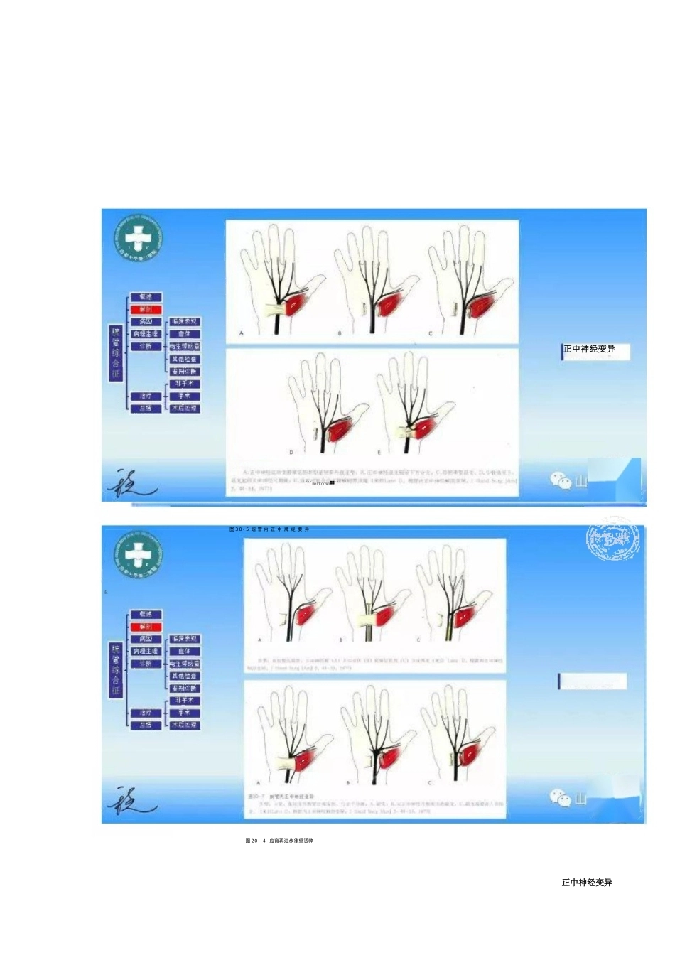 腕管综合征的诊断与治 疗策略_第5页