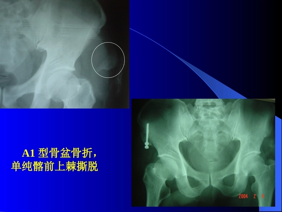 骨盆骨折-诊断与分型_第12页