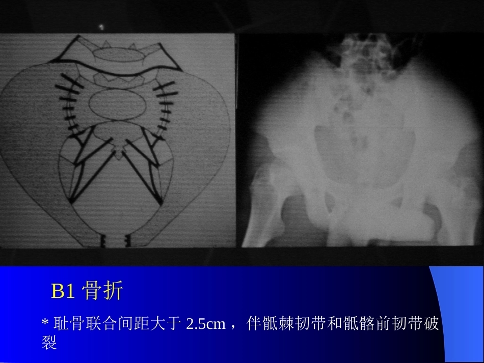 骨盆骨折-诊断与分型_第14页