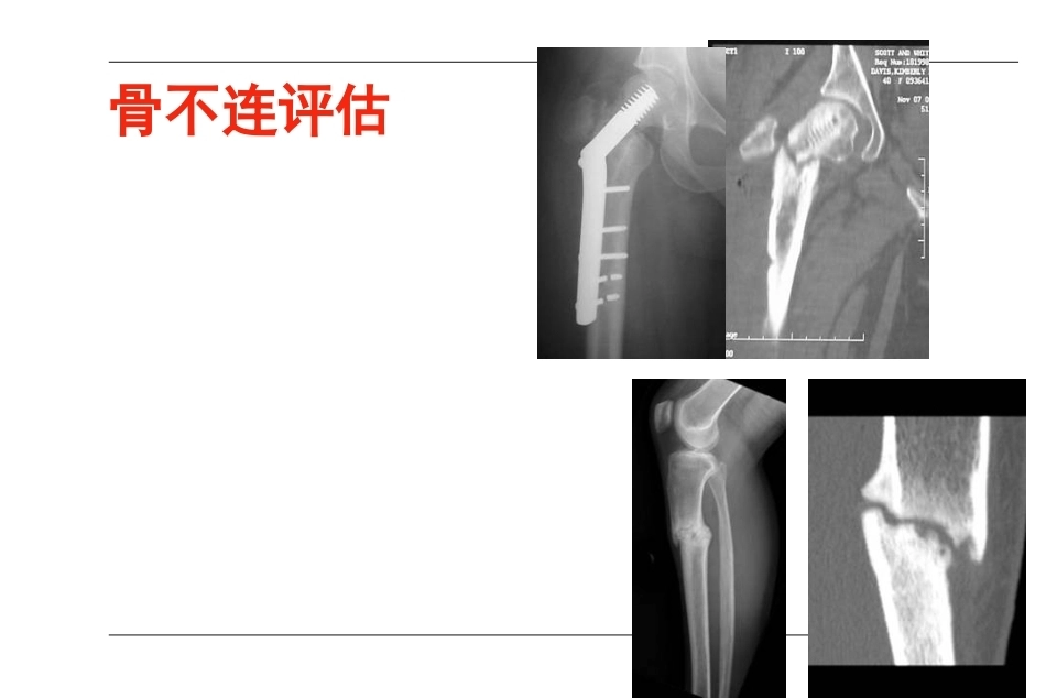 AO-骨不连和骨延迟愈合_第10页