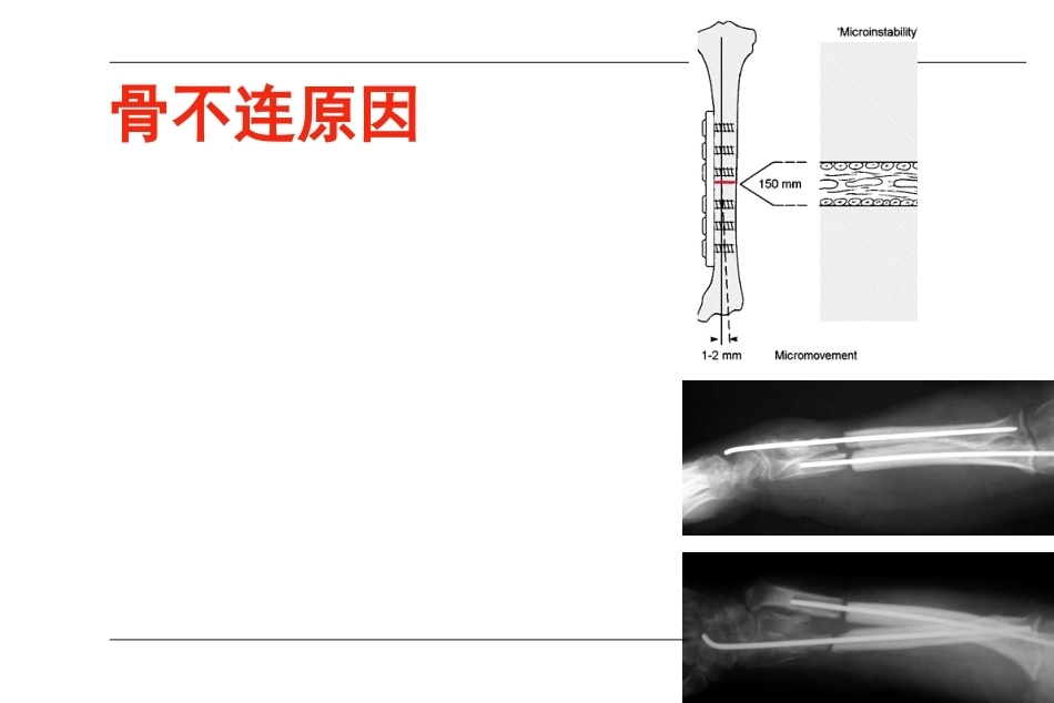 AO-骨不连和骨延迟愈合_第11页