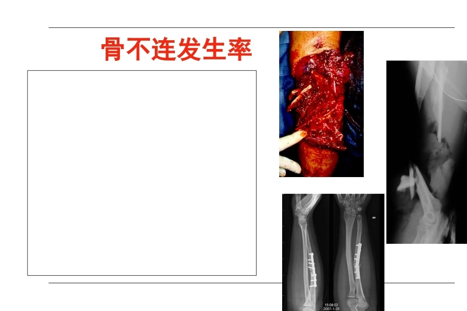 AO-骨不连和骨延迟愈合_第4页