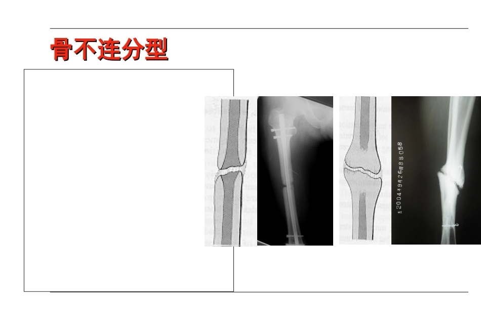 AO-骨不连和骨延迟愈合_第6页