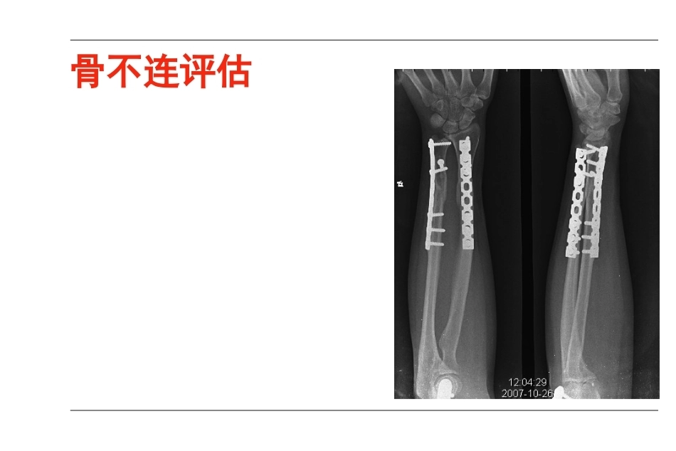 AO-骨不连和骨延迟愈合_第9页
