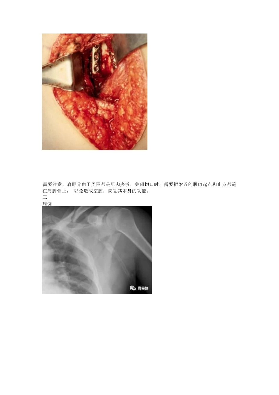 肩胛骨骨折的 内固定手术技巧_第12页