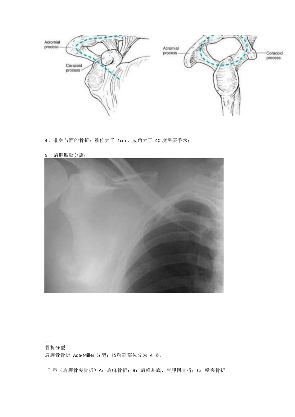 肩胛骨骨折的 内固定手术技巧_第3页