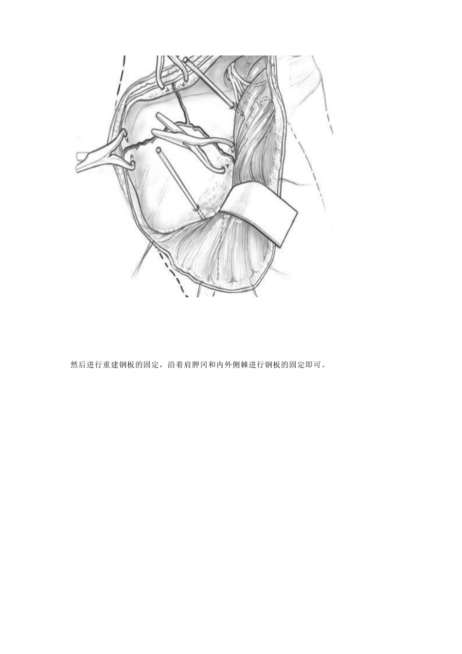 肩胛骨骨折的 内固定手术技巧_第8页