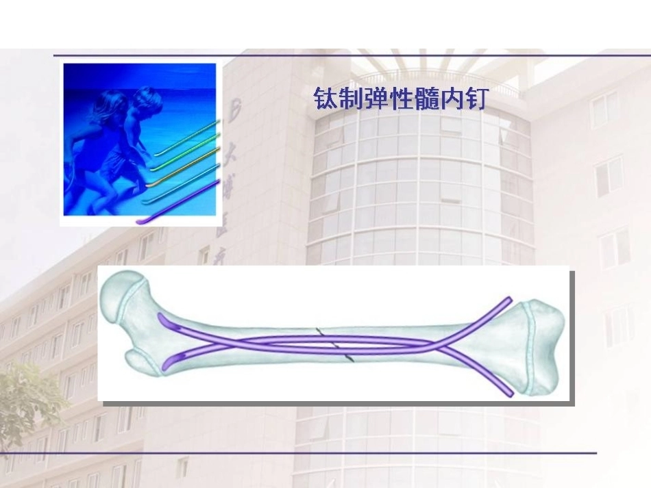弹性髓内 钉治疗儿童骨折操作技巧_第1页