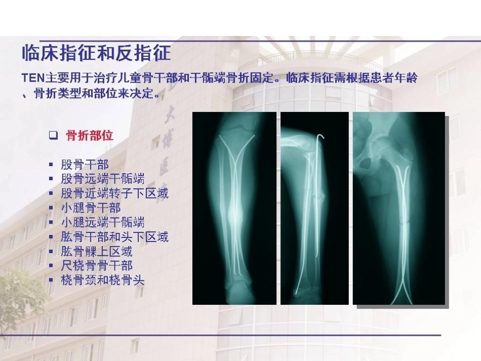弹性髓内 钉治疗儿童骨折操作技巧_第5页