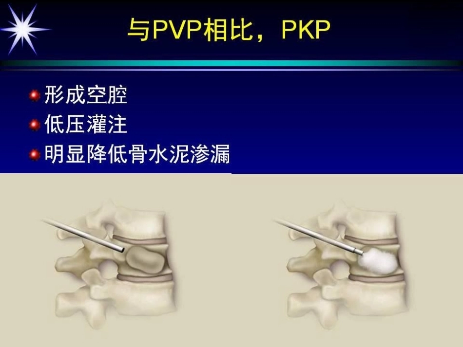 如何防止椎体强 化术中并发症_第10页