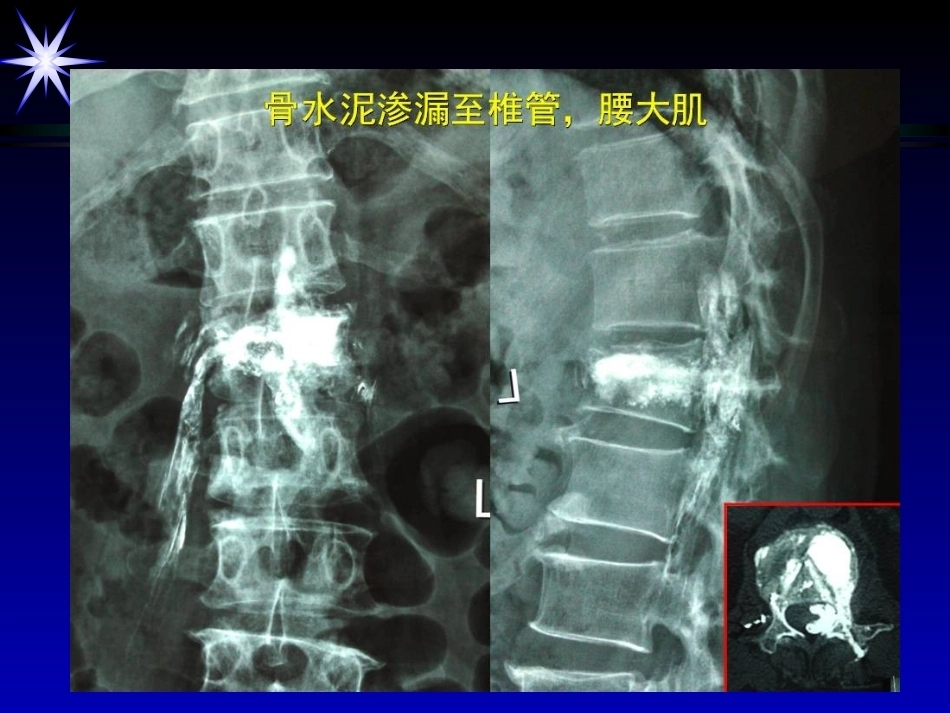 如何防止椎体强 化术中并发症_第5页