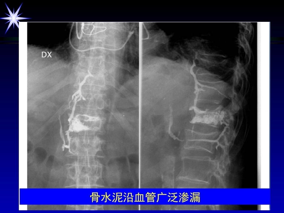 如何防止椎体强 化术中并发症_第6页