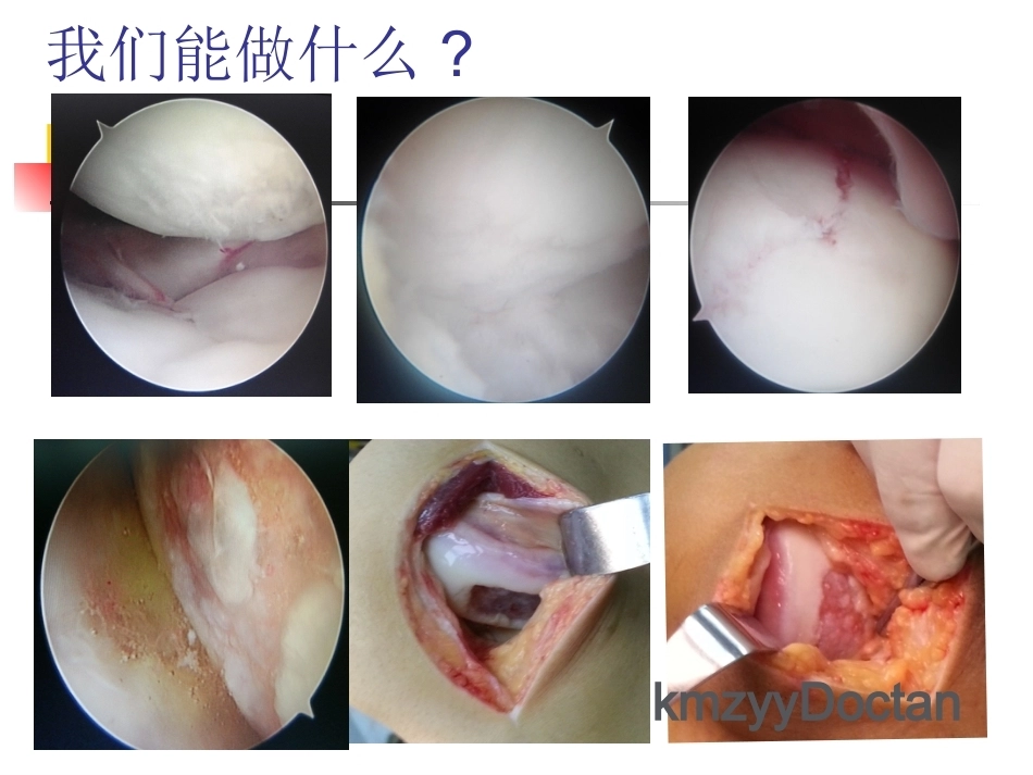 软骨修复_第3页