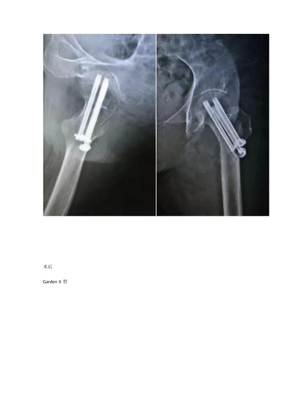 股骨颈骨折的分型与治疗策略_第10页