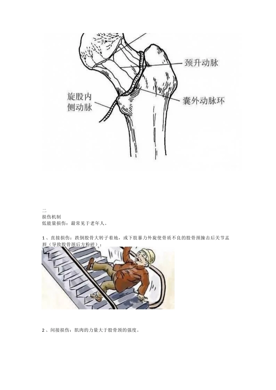 股骨颈骨折的分型与治疗策略_第3页