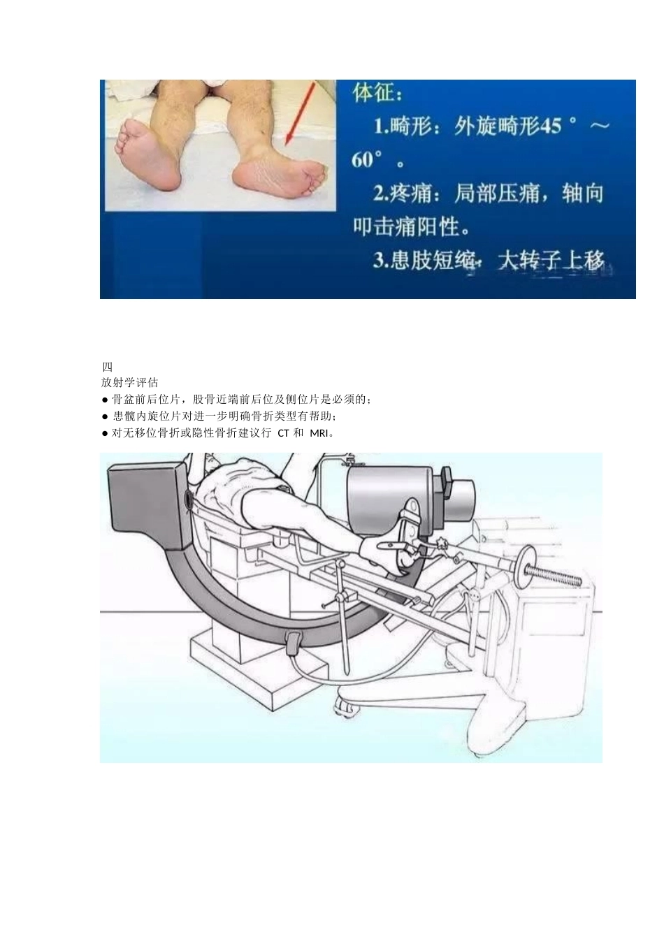 股骨颈骨折的分型与治疗策略_第5页