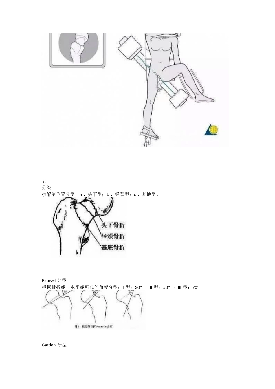 股骨颈骨折的分型与治疗策略_第6页
