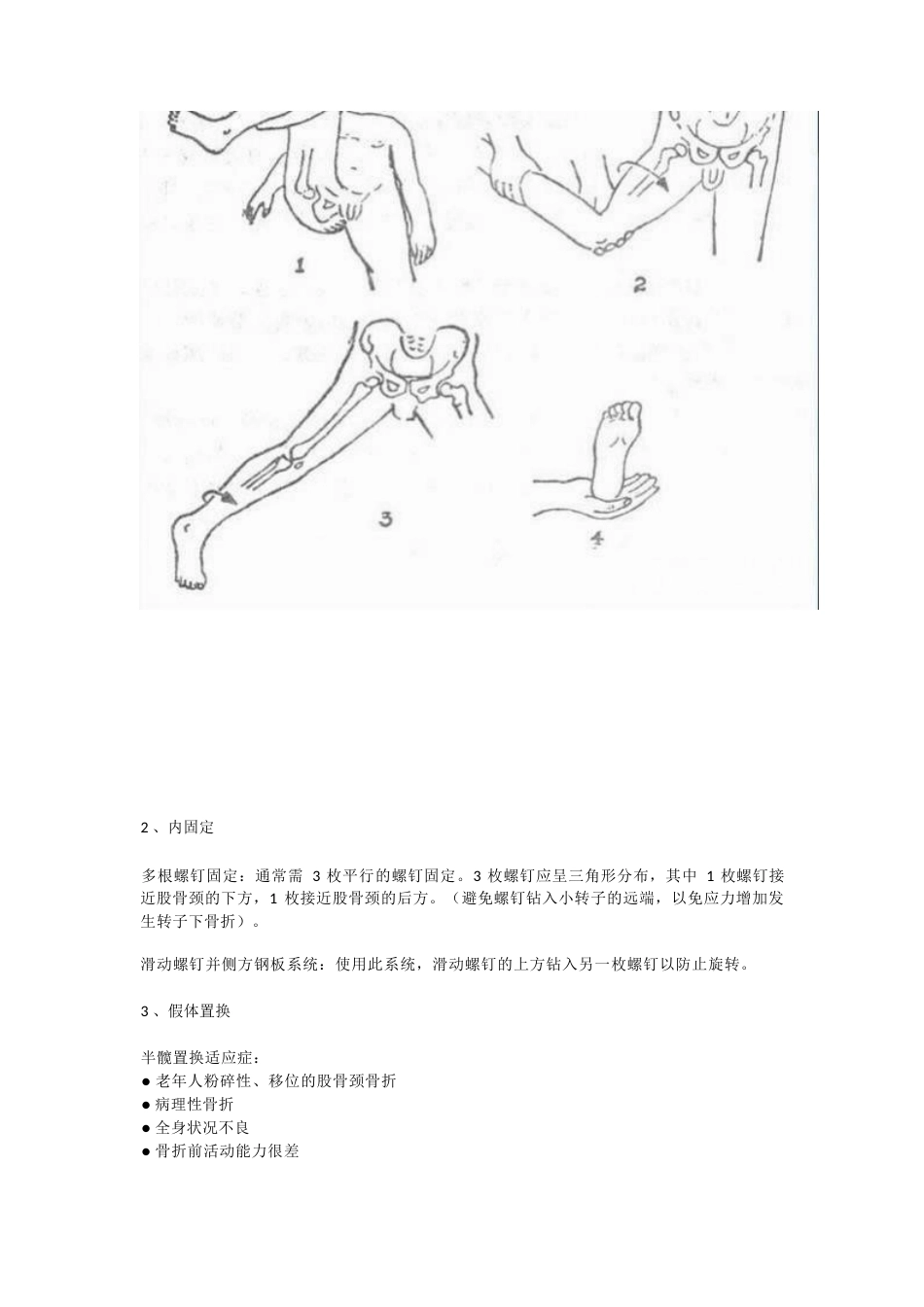 股骨颈骨折的分型与治疗策略_第8页