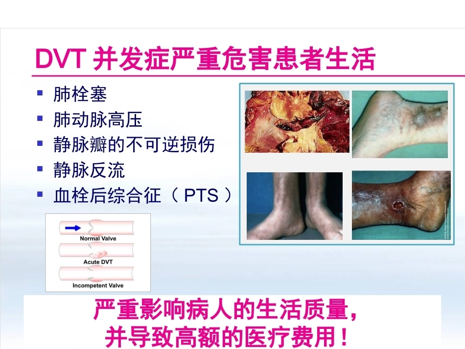 创伤骨科患者的VTE预防_第4页