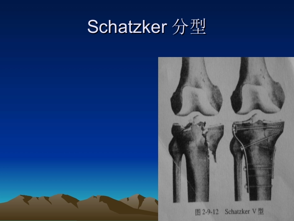 胫骨平台骨折的诊断及治疗_第11页
