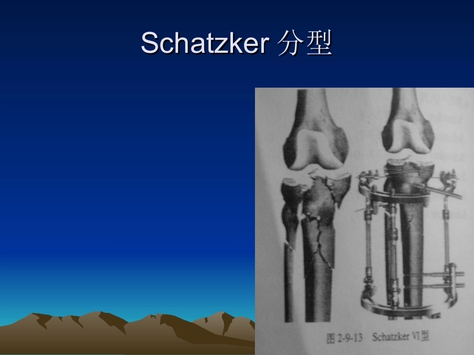 胫骨平台骨折的诊断及治疗_第12页