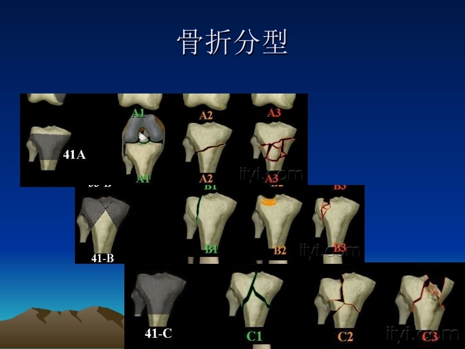 胫骨平台骨折的诊断及治疗_第5页