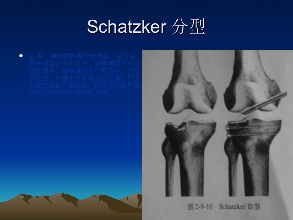 胫骨平台骨折的诊断及治疗_第9页
