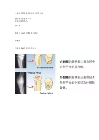TKA中骨缺损的分型
