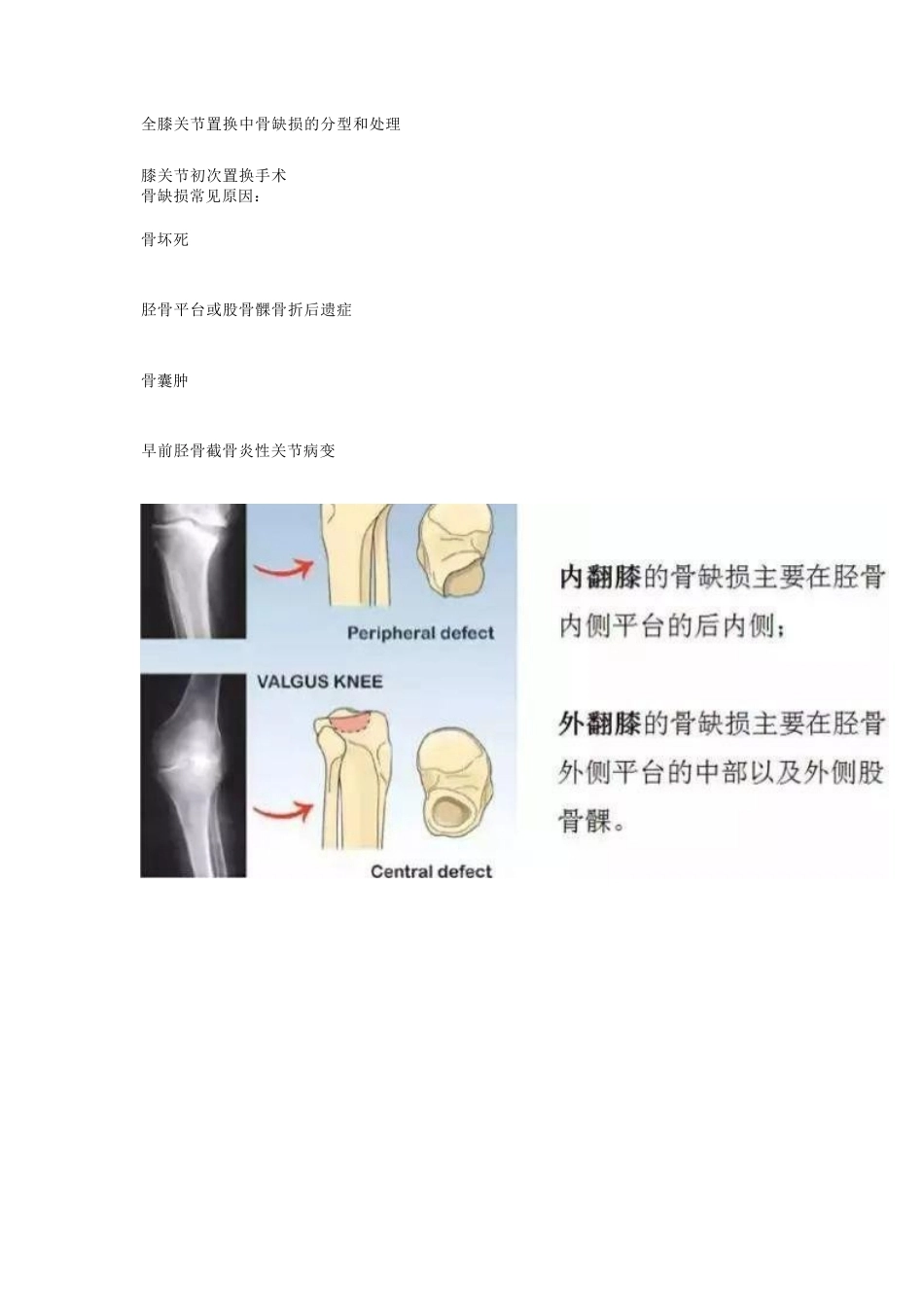 TKA中骨缺损的分型_第1页