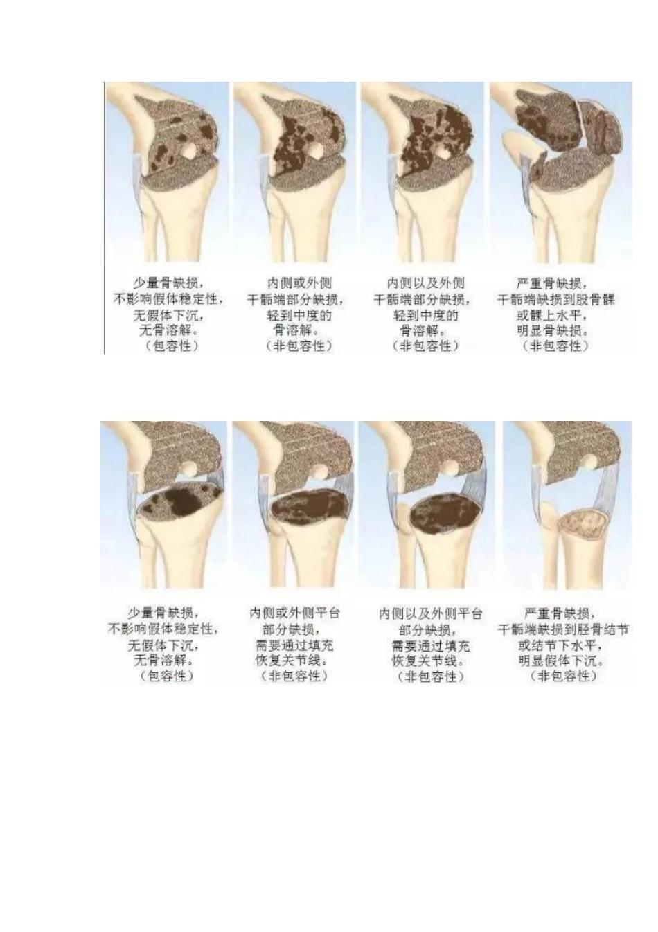 TKA中骨缺损的分型_第3页