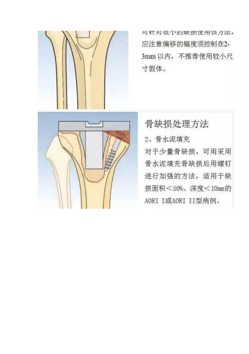 TKA中骨缺损的分型_第4页