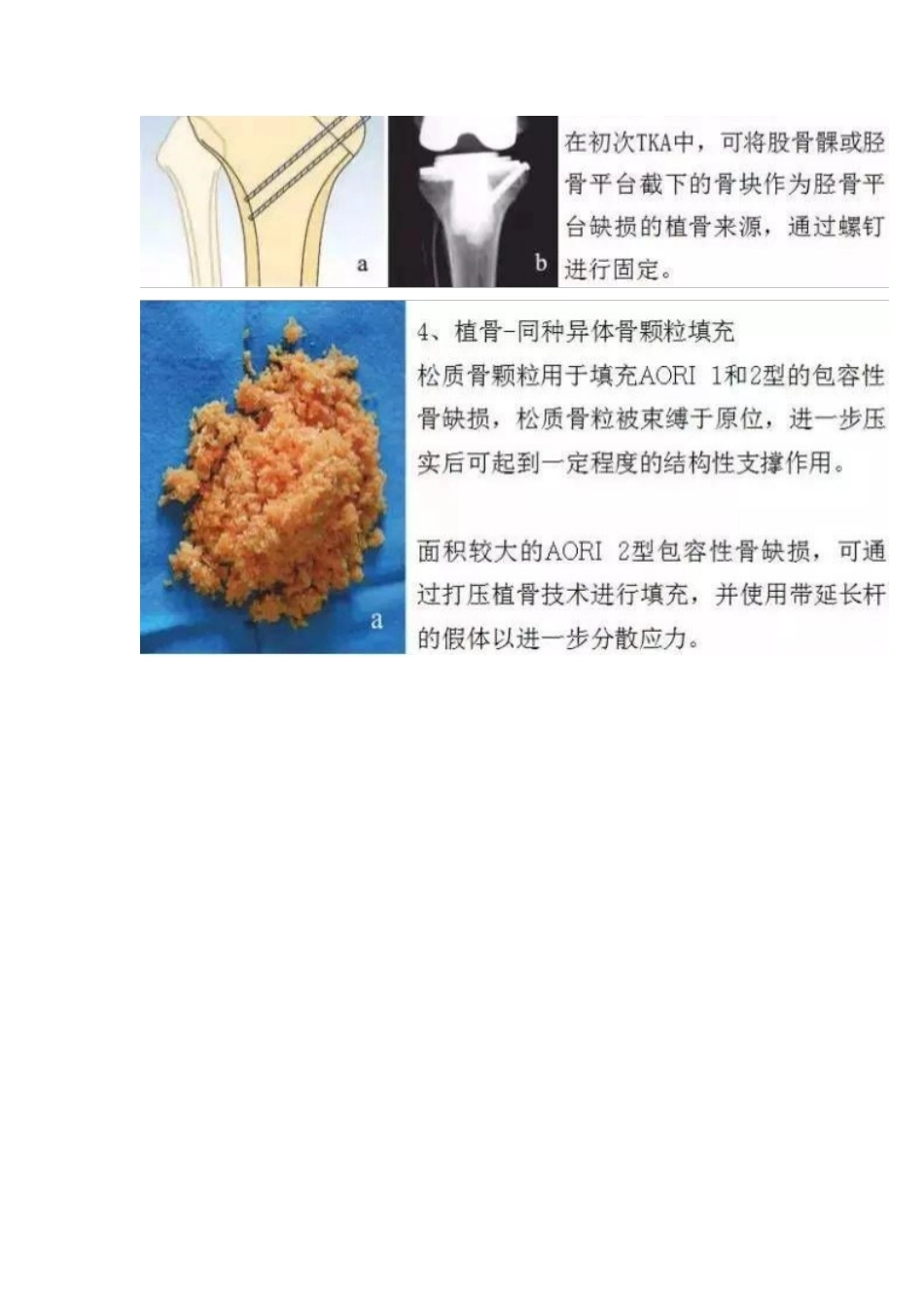 TKA中骨缺损的分型_第5页