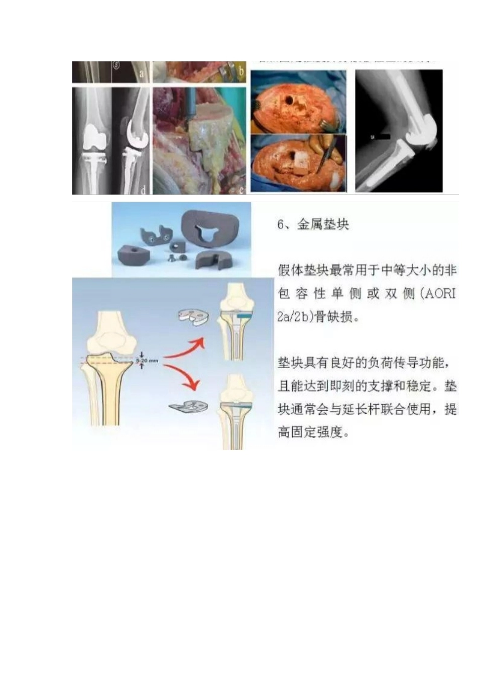 TKA中骨缺损的分型_第6页