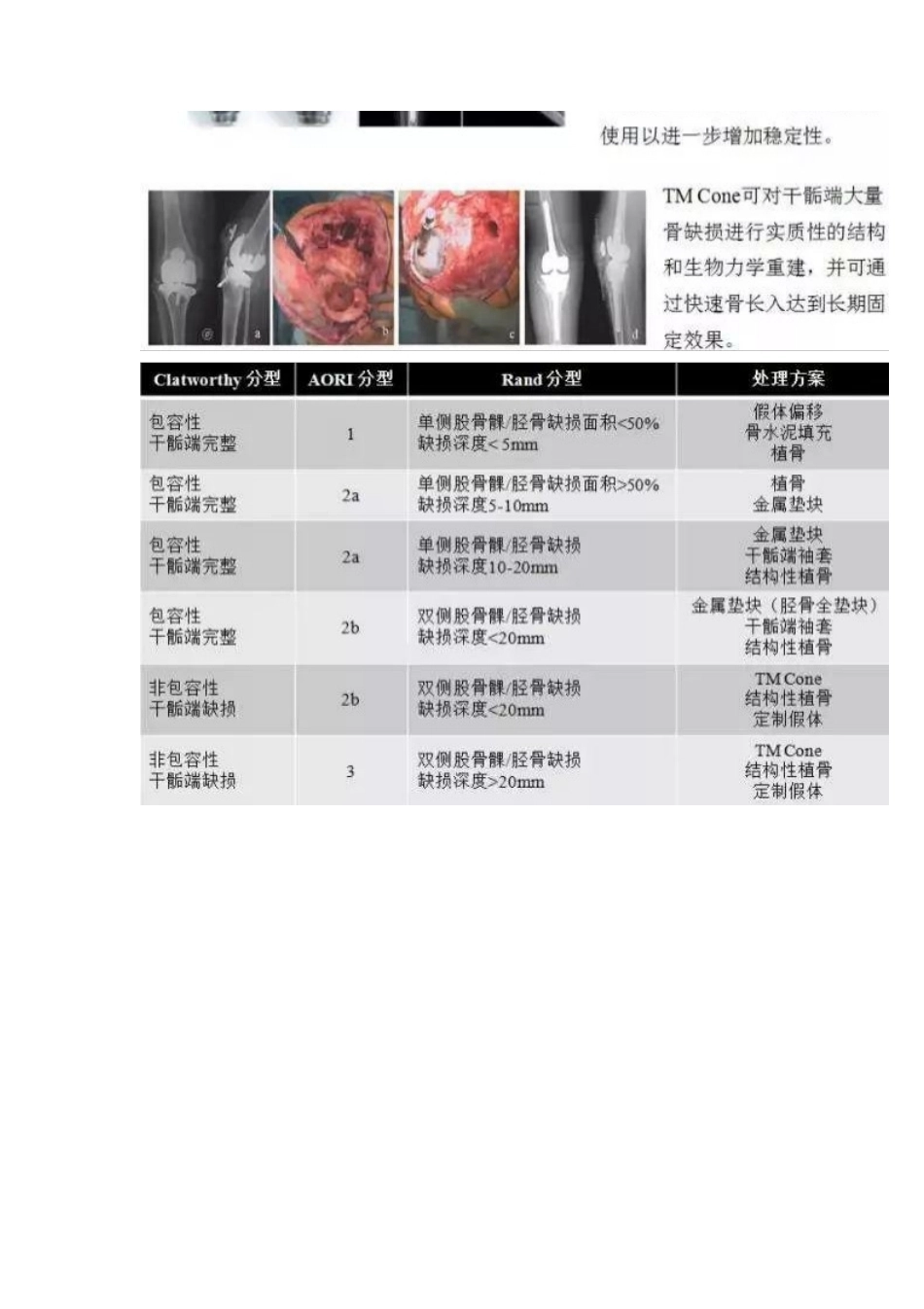 TKA中骨缺损的分型_第7页