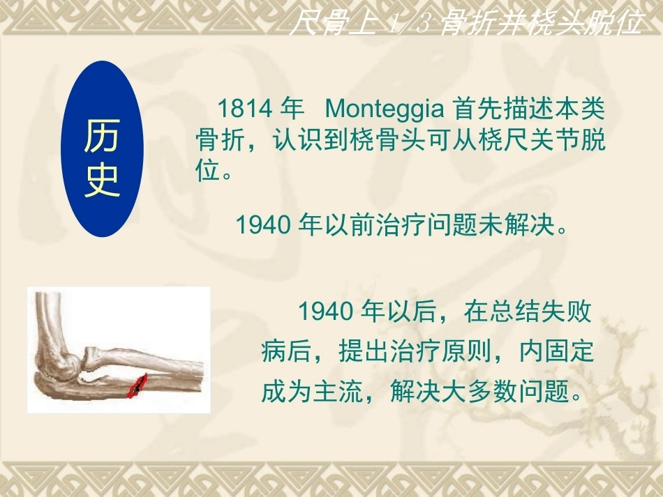 孟氏骨折_第3页