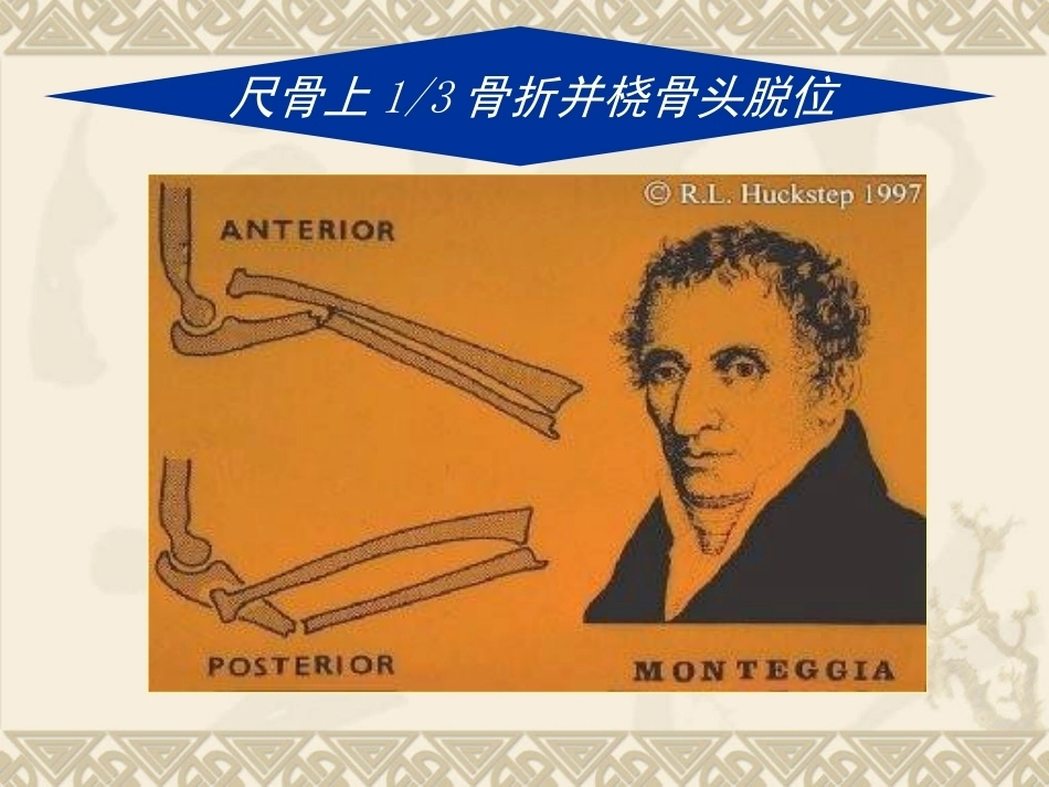 孟氏骨折_第4页