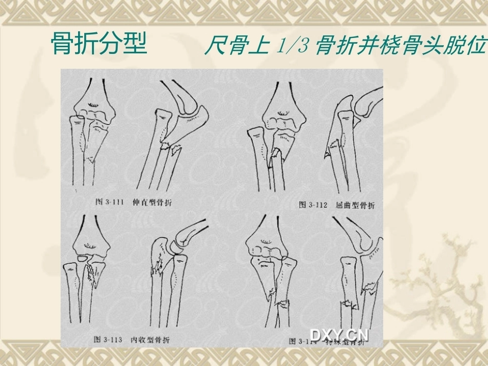 孟氏骨折_第9页