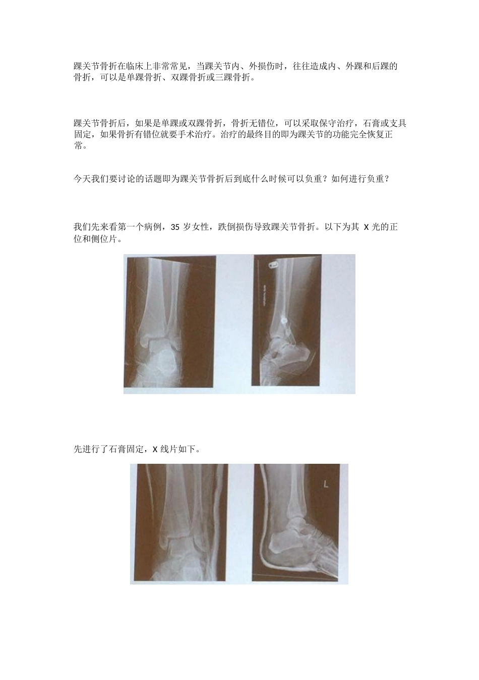 踝关节骨折后到底什么时候负重_第1页