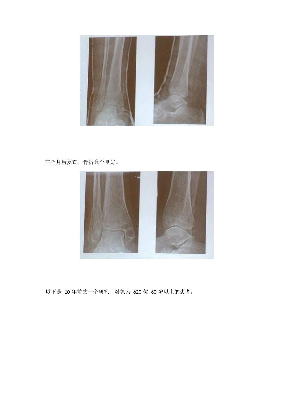 踝关节骨折后到底什么时候负重_第10页