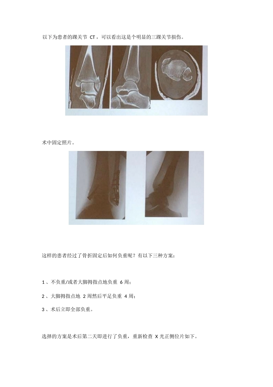 踝关节骨折后到底什么时候负重_第2页